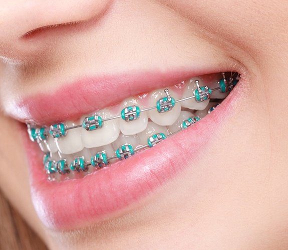 Closeup of beautiful smile with traditional braces in Lockport, IL