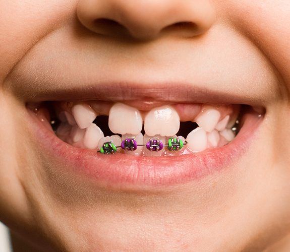Child with phase one pediatric orthodontics in place