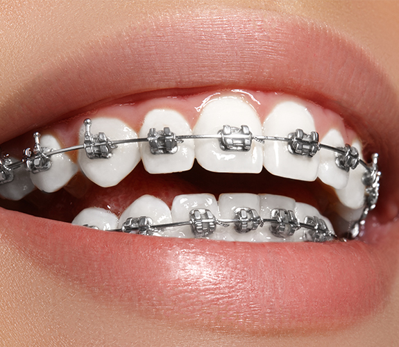 Closeup of smile with metal braces