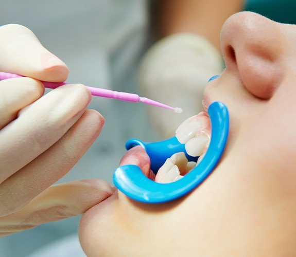 Patient receiving fluoride treatment