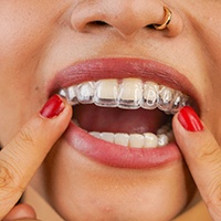 Woman inserting a clear aligner