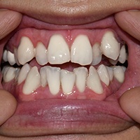 Crowded set of teeth