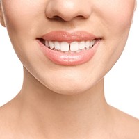 Up-close view of a gap between two front teeth