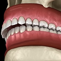 Image of an overbite