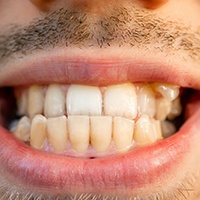 Image of an underbite