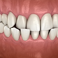 Crossbite with teeth overlapping