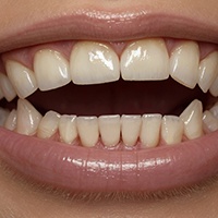 Front upper and lower teeth not touching