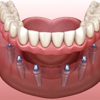 Implant dentures in Lockport 