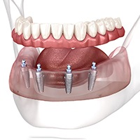 Implant dentures