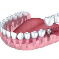 Implant bridge in Lockport