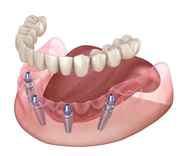 Implant dentures on the lower arch