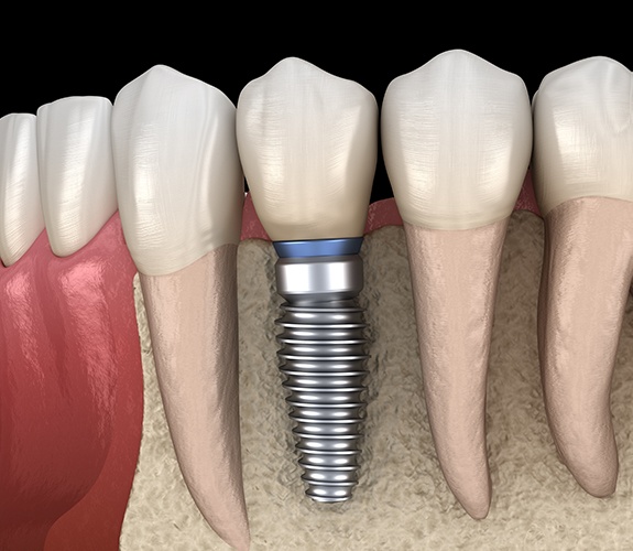 Animated smile with dental implant supported replacement tooth