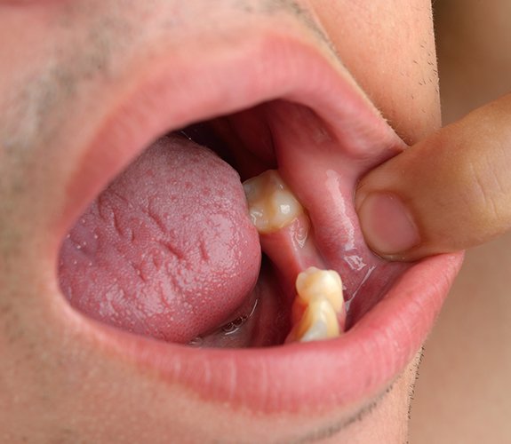 Closeup of smile with missing bottom tooth