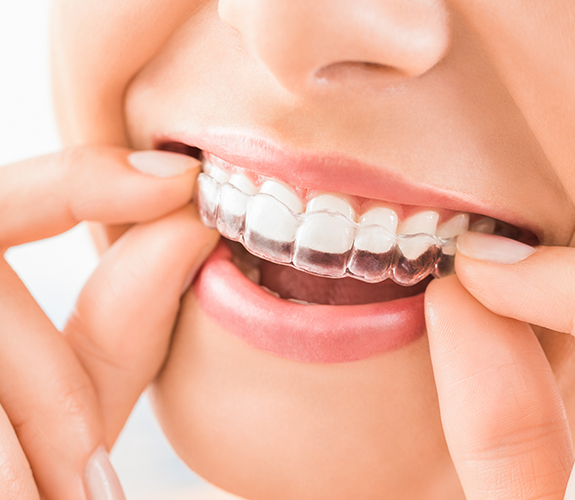 Woman placing Invisalign tray