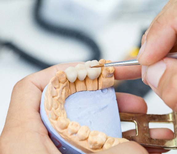 Dental bridge in Lockport being created