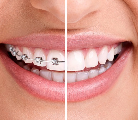 Close-up of smile during and after orthodontics in Lockport, IL
