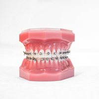 Model of braces for orthodontics in Lockport, IL