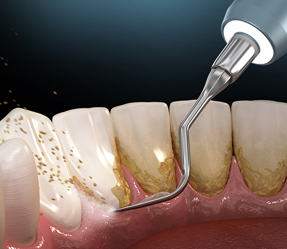 Animated smile during periodontal treatment