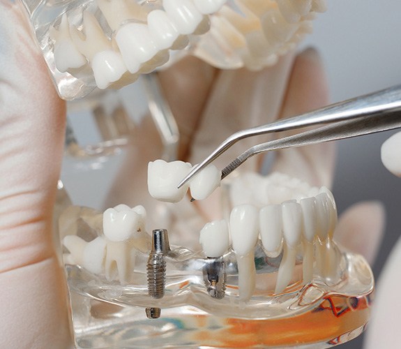 How dental implants work in Lockport 