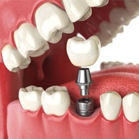 Dental implant in Lockport 