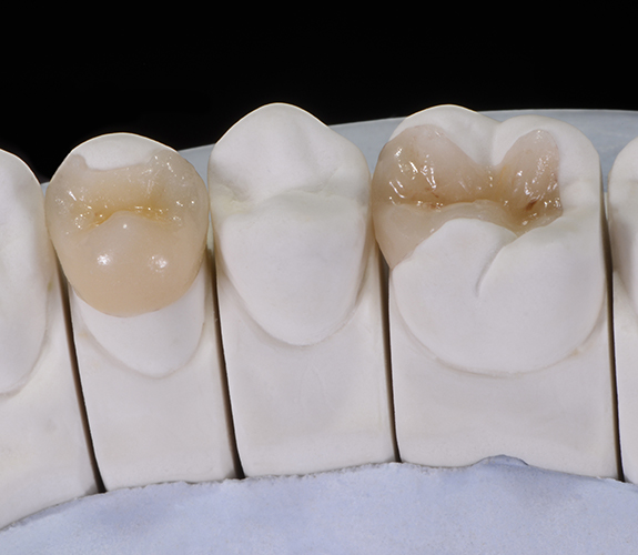 Model smile with porcelain inlay and onlay restorations visible