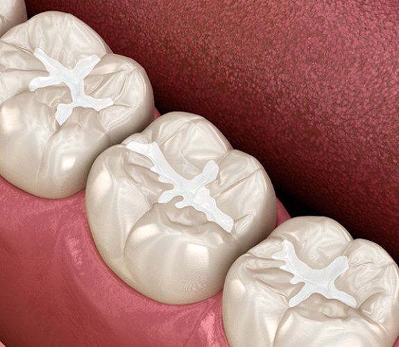 Digital illustration of tooth-colored fillings