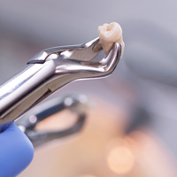 Dental pliers with an extracted tooth 