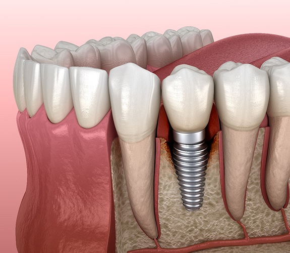 Failed dental implant