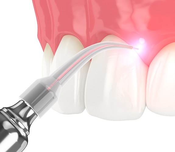 Illustration of soft tissue laser dentistry in Lockport