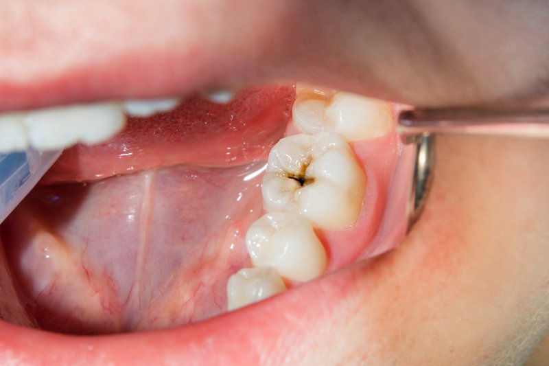 a dental cavity