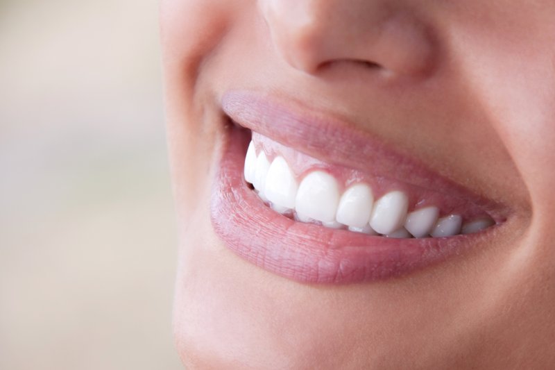 woman with veneers