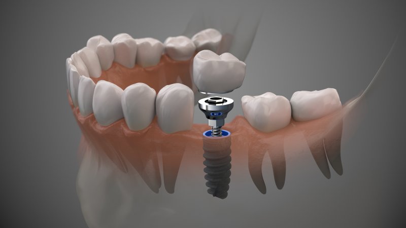 digital image of a dental implant