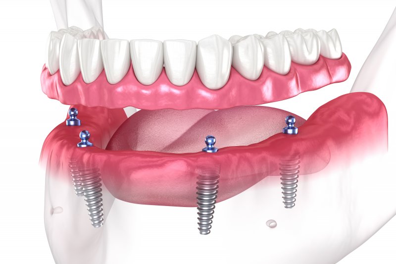 digital image of implant denture