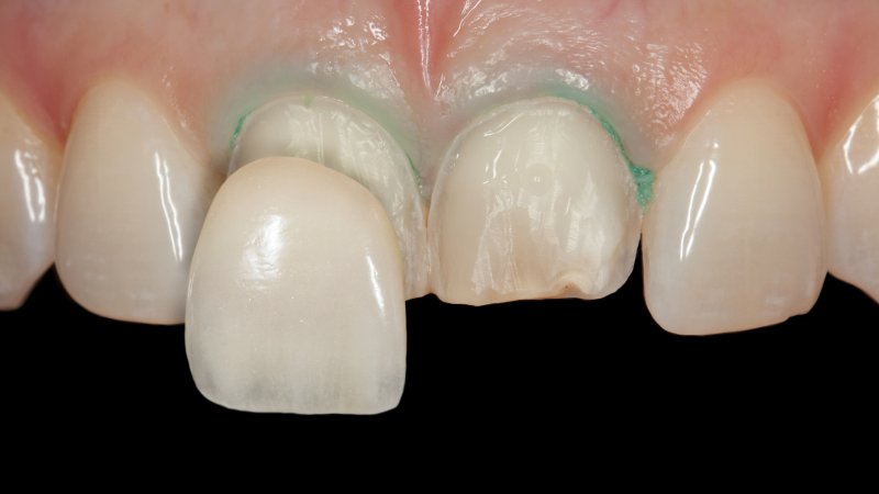 Up-close view of person receiving veneers